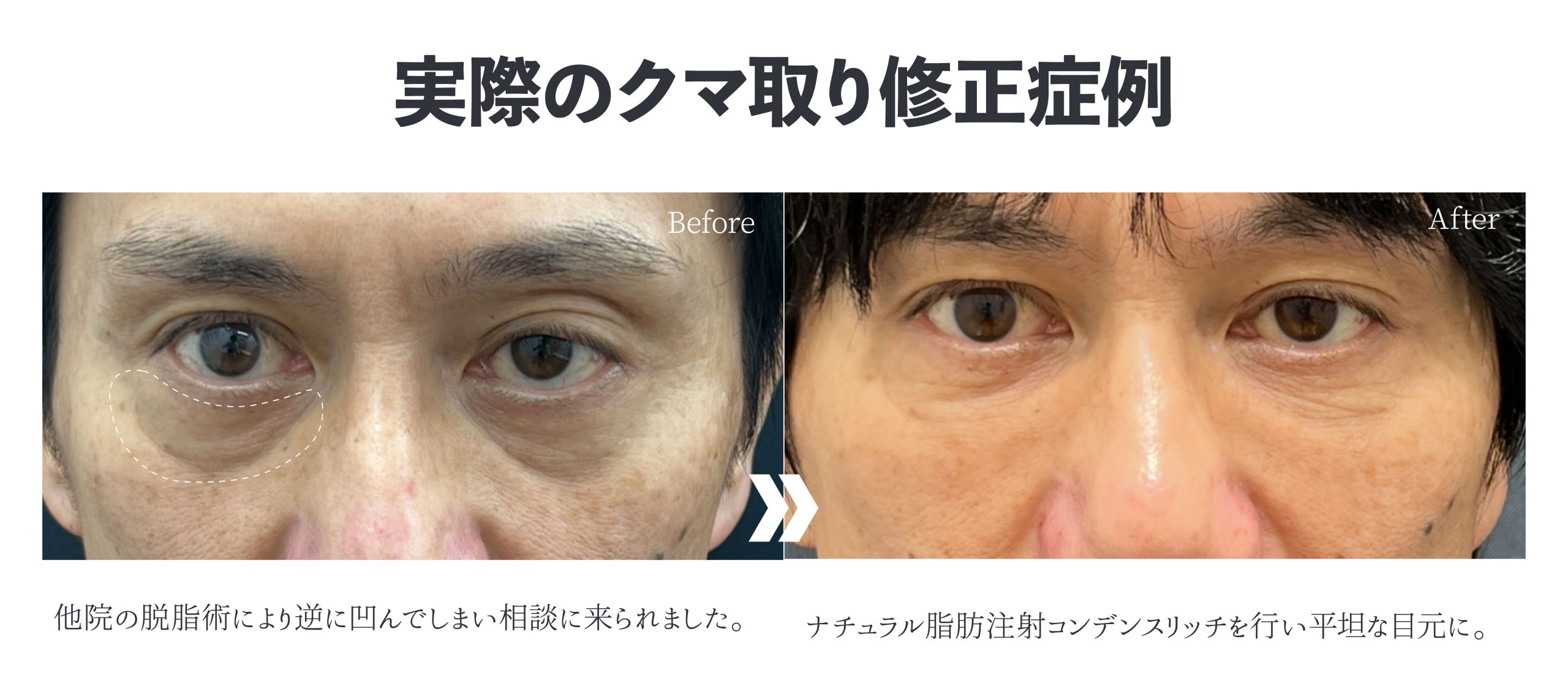 クマ取りで後悔する人の共通点とは？脱脂だけで凹んでしまう理由と後悔 