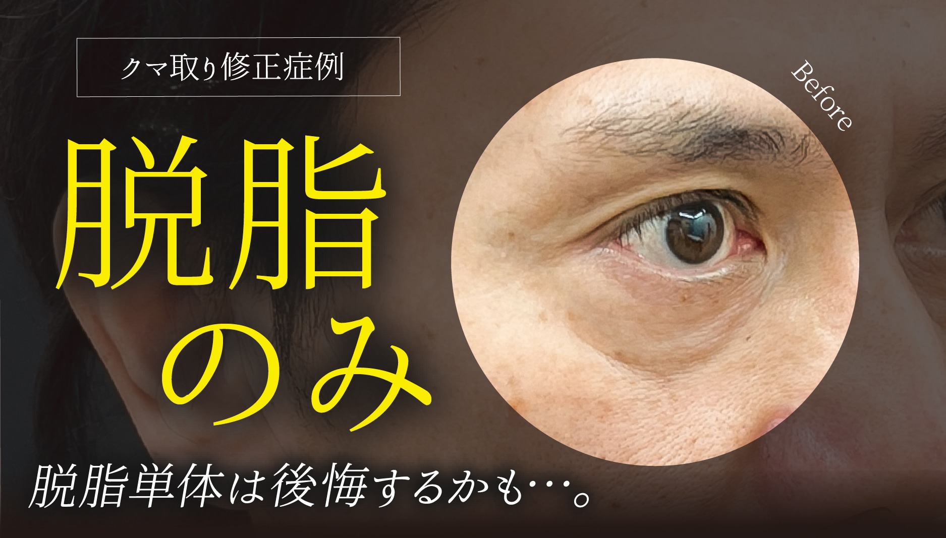 クマ取りで後悔する人の共通点とは?脱脂だけで凹んでしまう理由と後悔しない選択肢