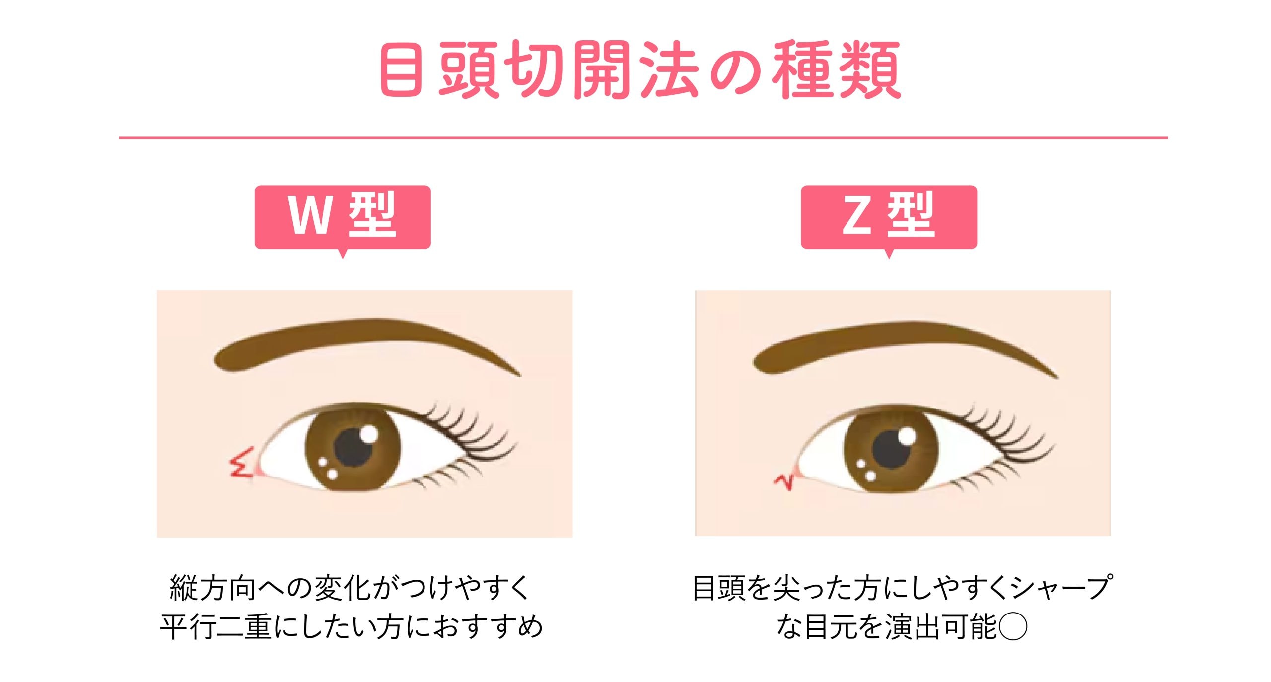 目頭切開