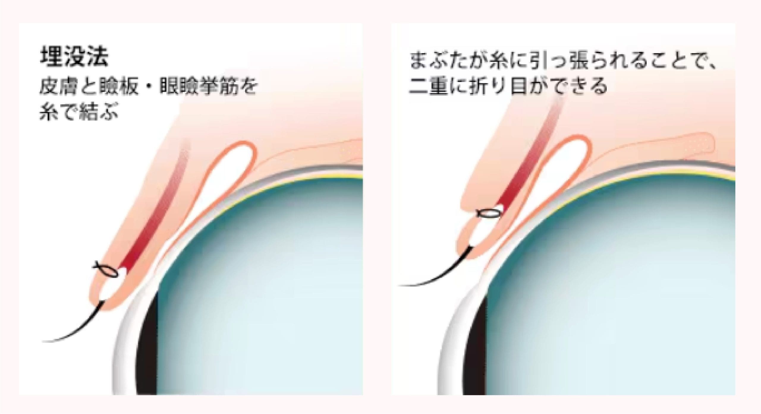 メスを使わず、糸でまぶたの折り目をつくる仕組み
