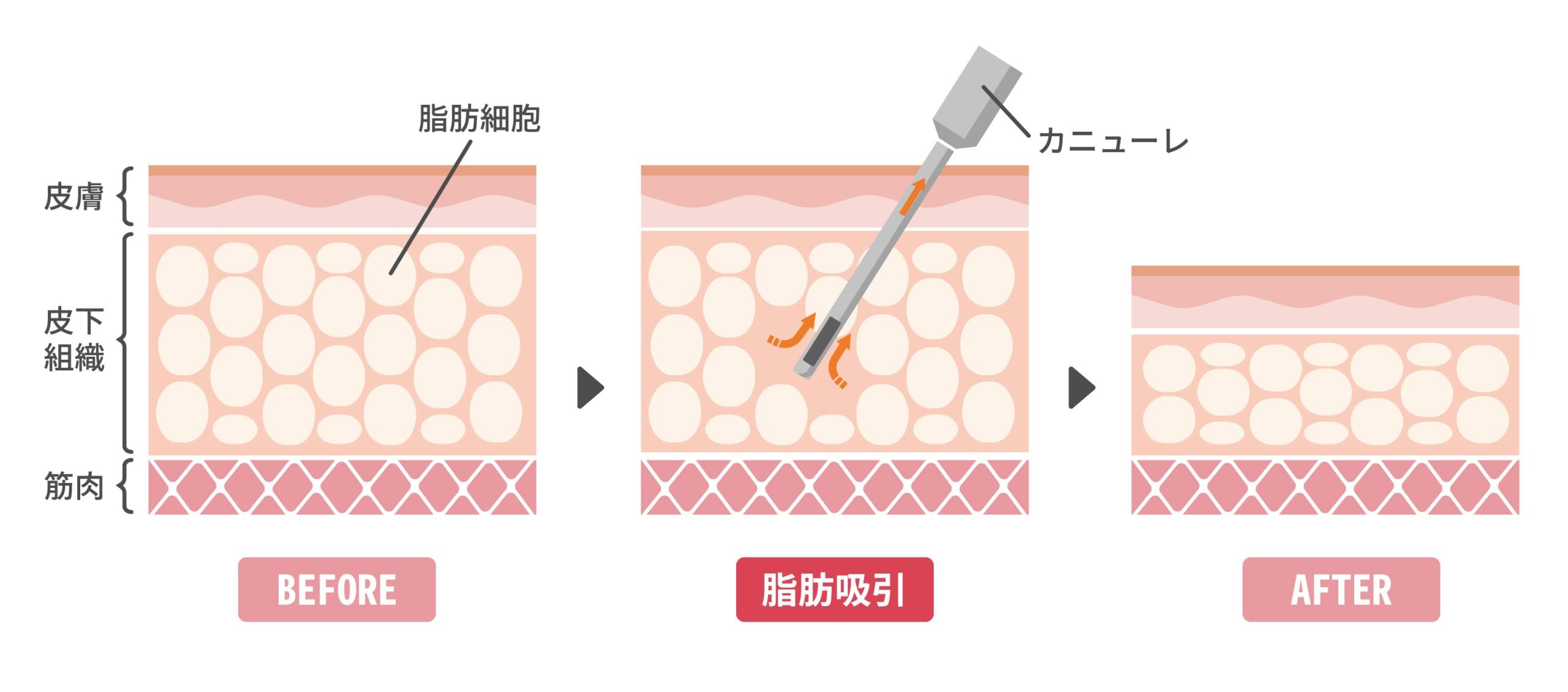 細い管を入れて、脂肪を直接抜き取る