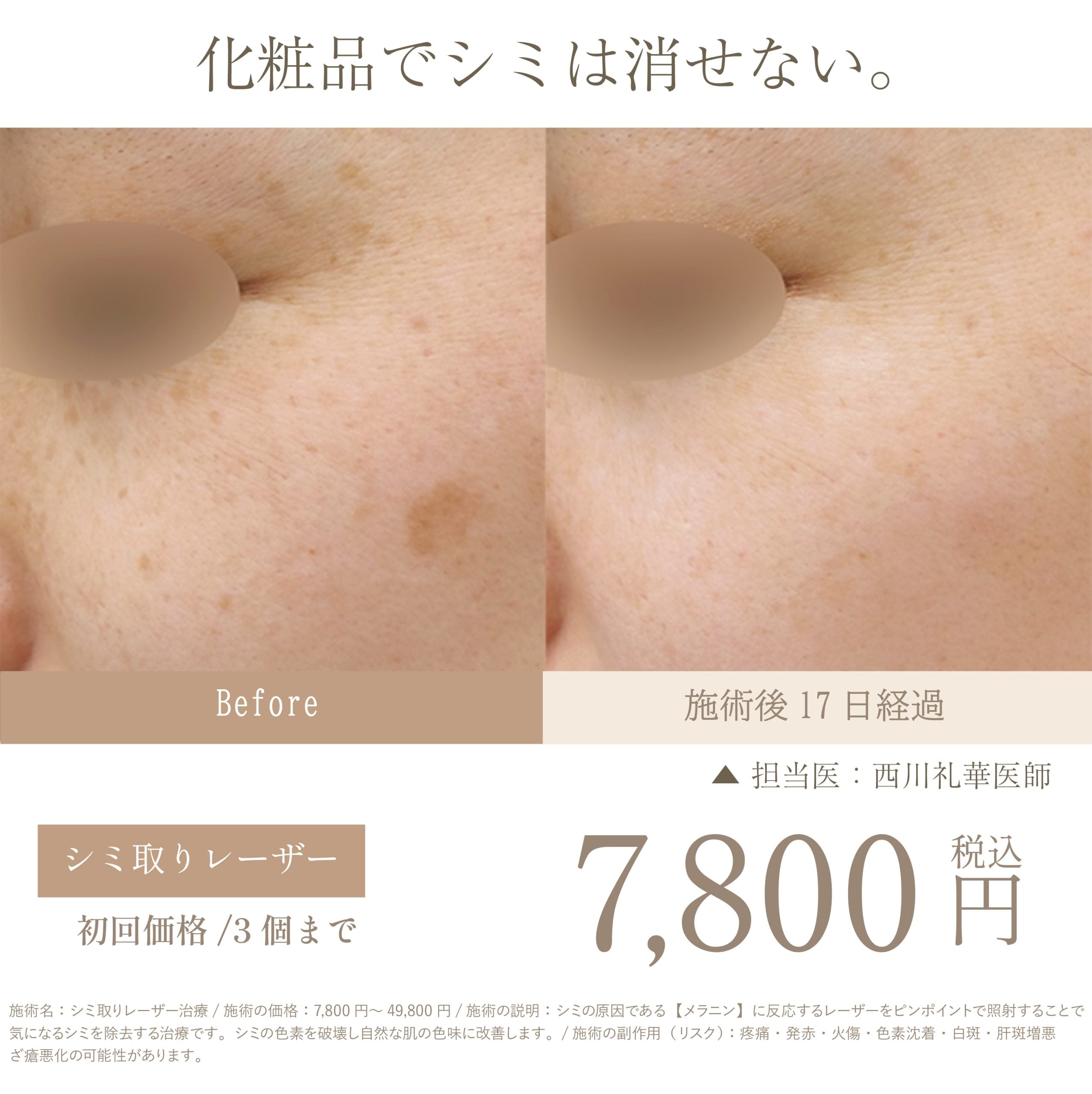 シミ取りレーザー