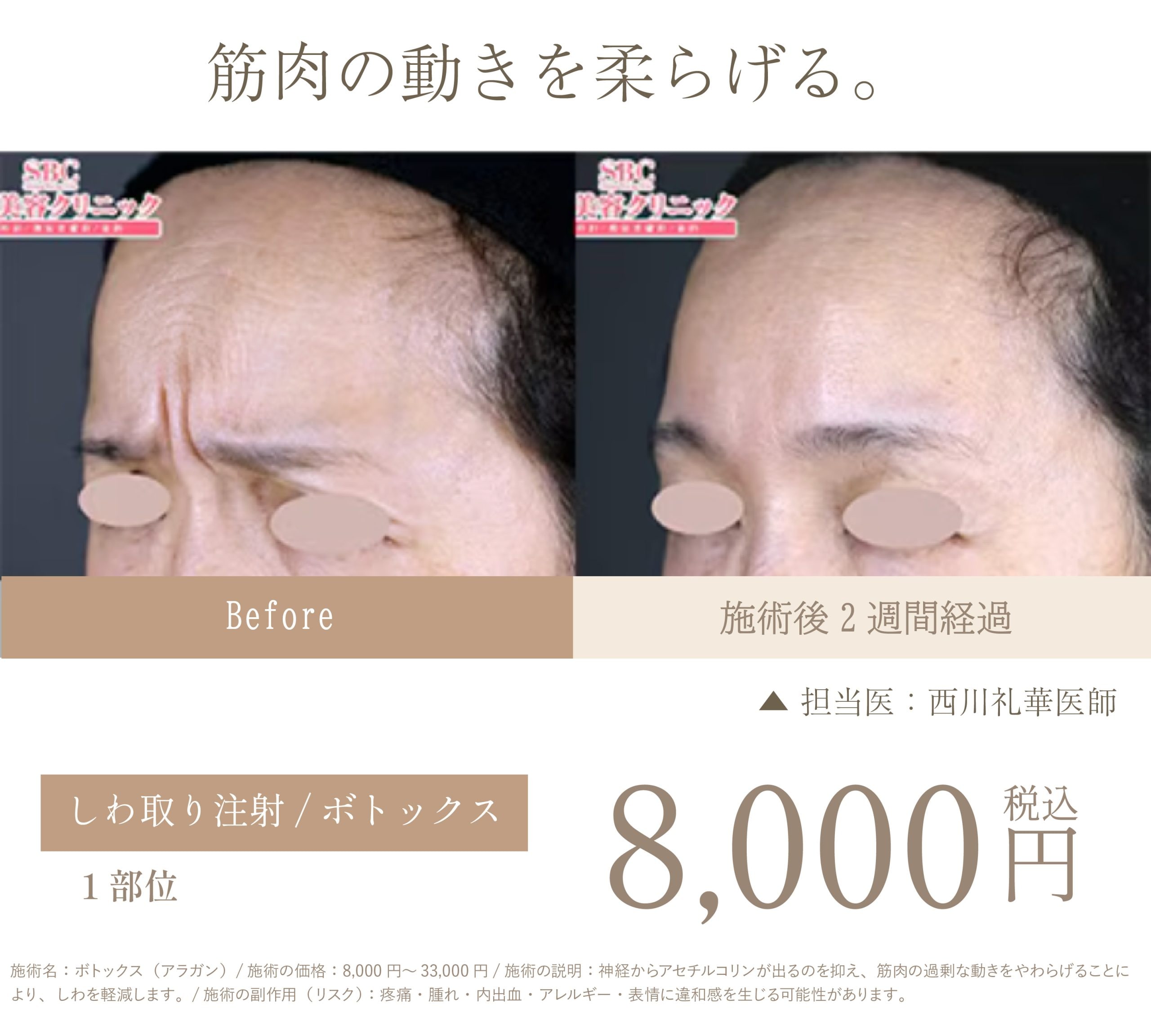 ボトックス〈シワ取り注射〉