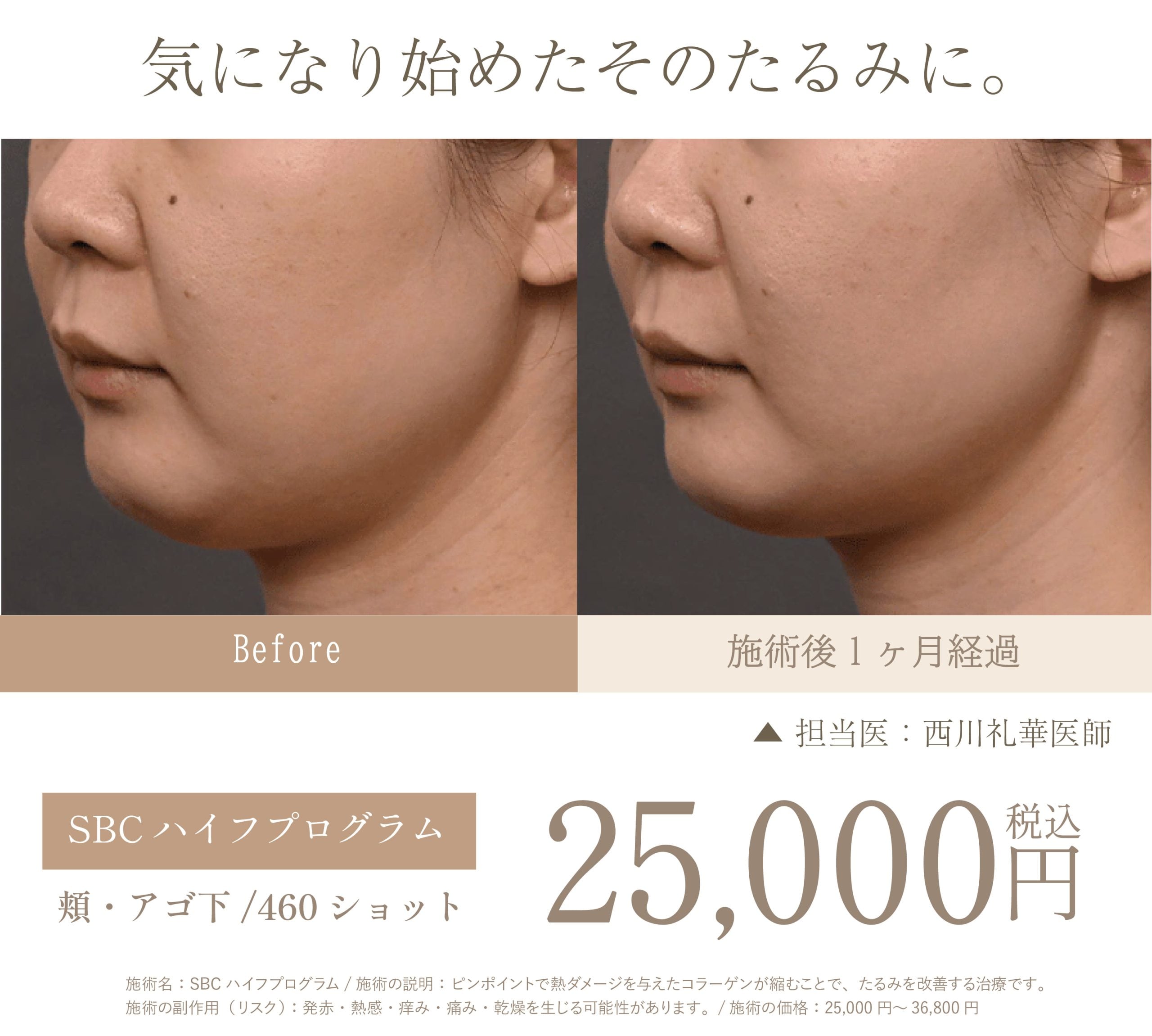 メディアで話題の「HIFU（ハイフ）」