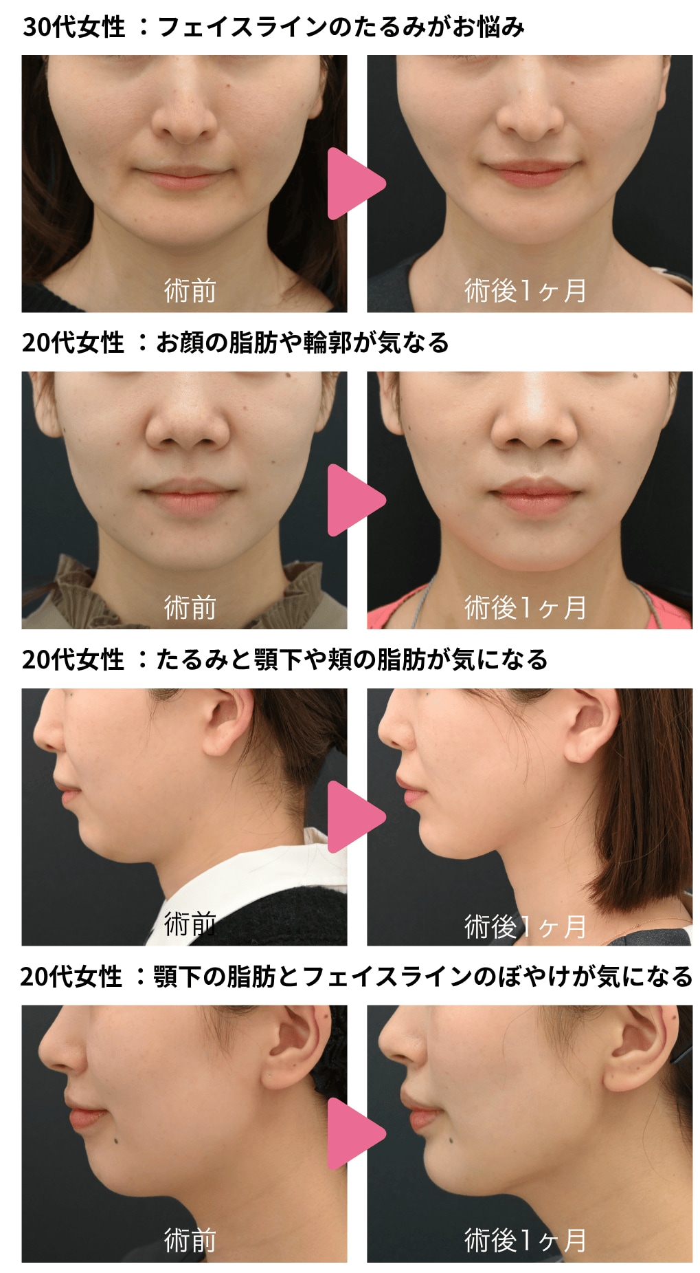 一人ひとりに合わせた“黄金比デザイン”の小顔術