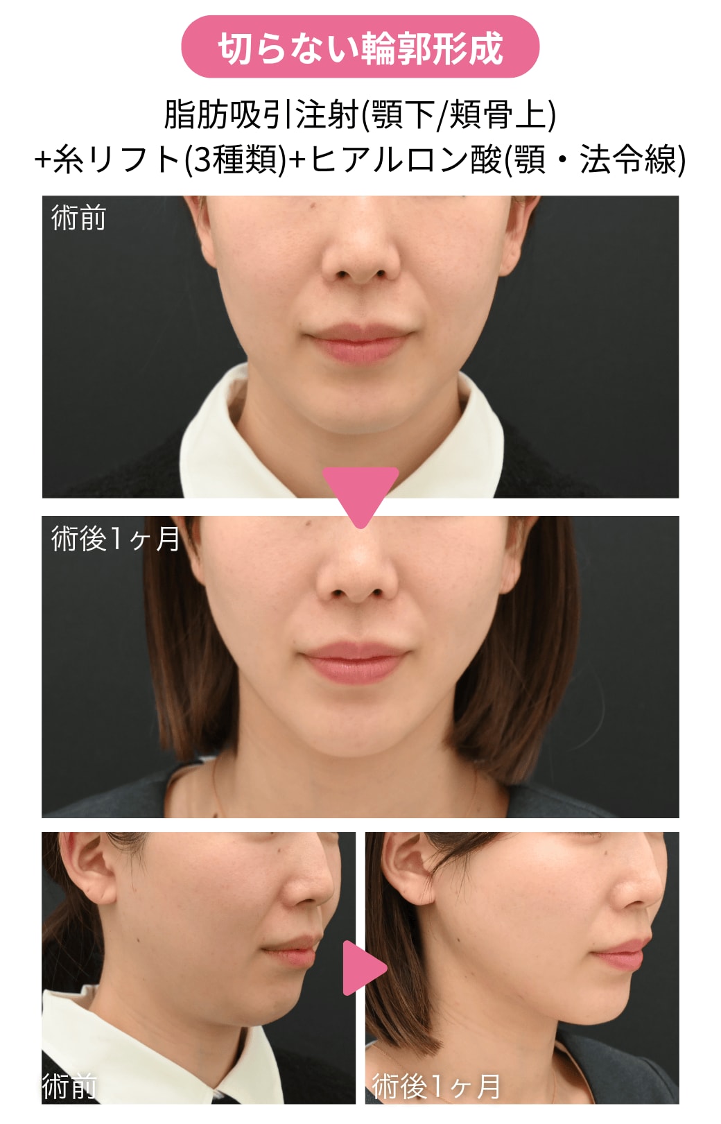 ▶︎ 20代後半女性|脂肪吸引注射+糸リフト+ヒアルロン酸