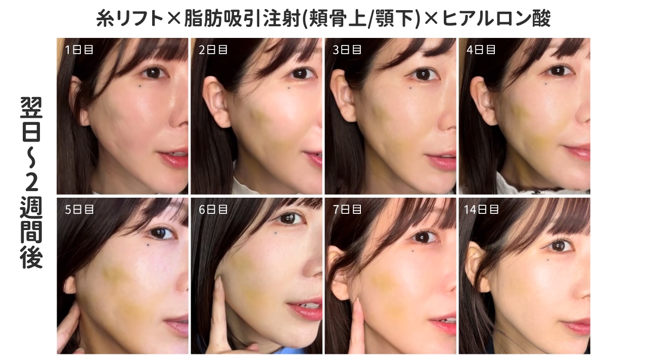 Q1. 輪郭形成のダウンタイムは?