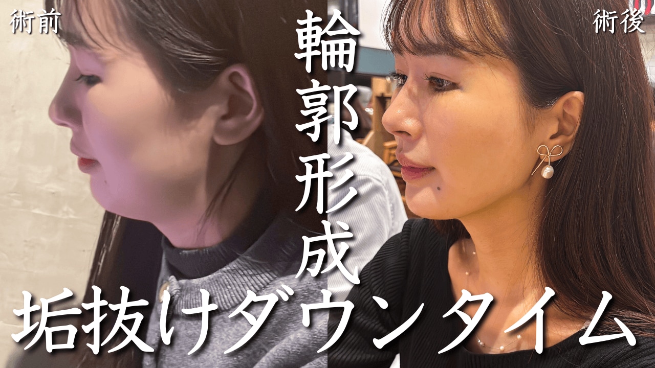 青葉台で人気の切らない輪郭形成のダウンタイム経過を大公開｜小顔脂肪吸引｜糸リフト｜脂肪注入