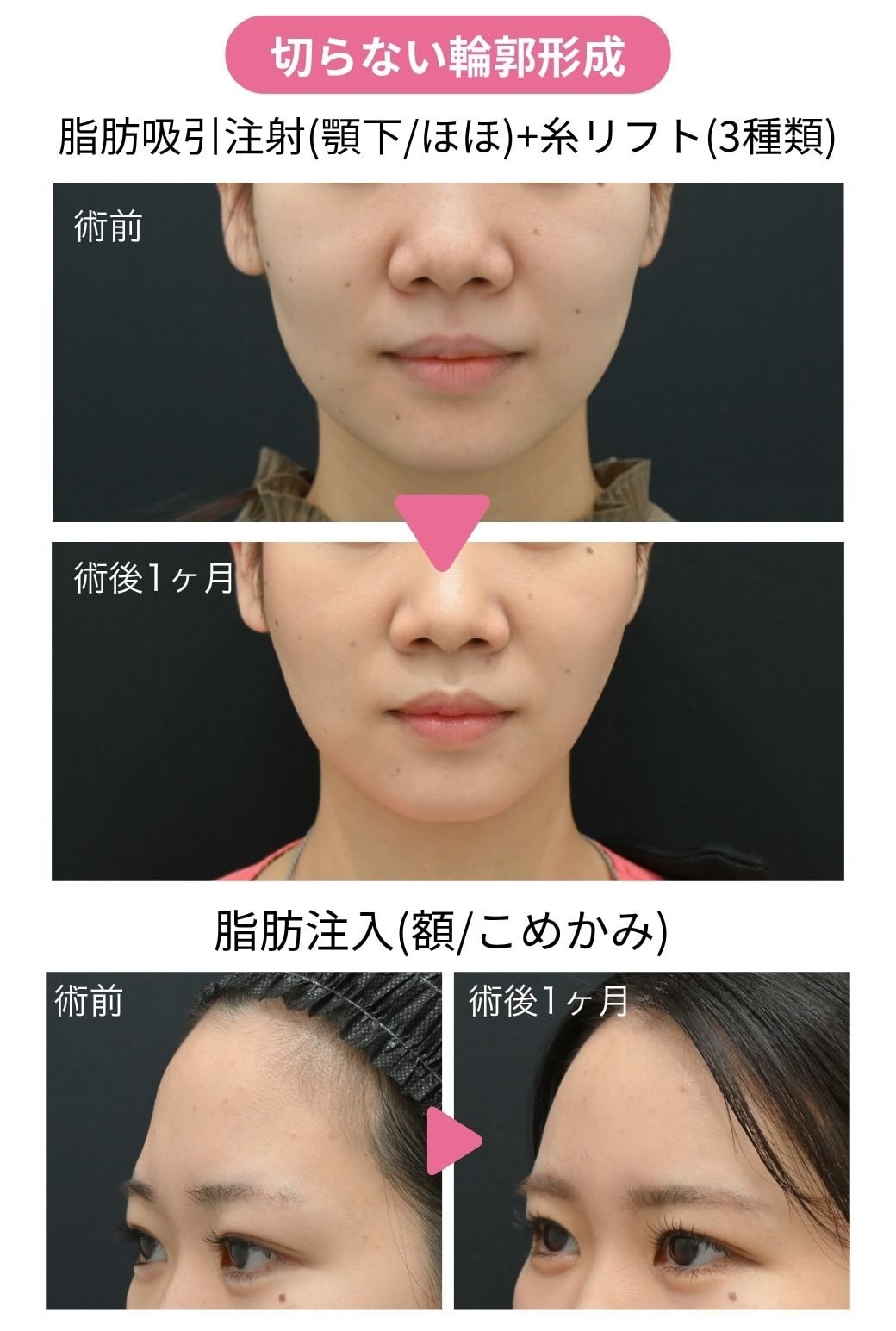 ▶︎ 20代後半女性|脂肪注入+脂肪吸引注射+糸リフト