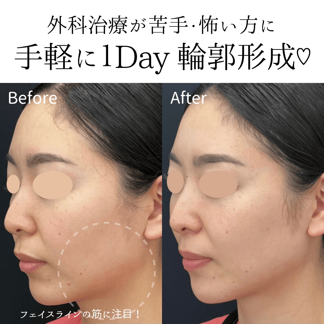 🫧即日から輪郭美人に<br />
▶ ヒアルロン酸輪郭形成(即効性◎)