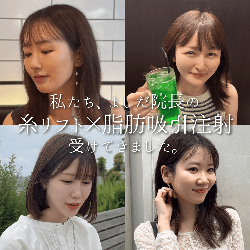 💃お出かけ前の印象チェンジに<br />
▶ 糸リフト+脂肪吸引注射(ダウンタイム最小限)