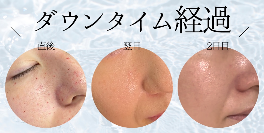 ダウンタイム経過