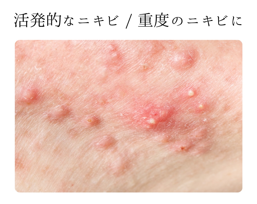 活発的なニキビにおすすめの治療