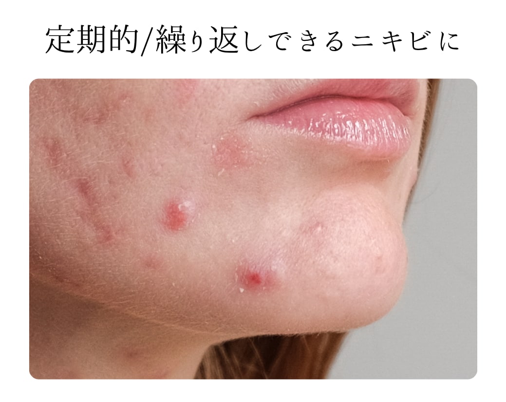 光治療【アクネライト】で内側からニキビを予防・改善!