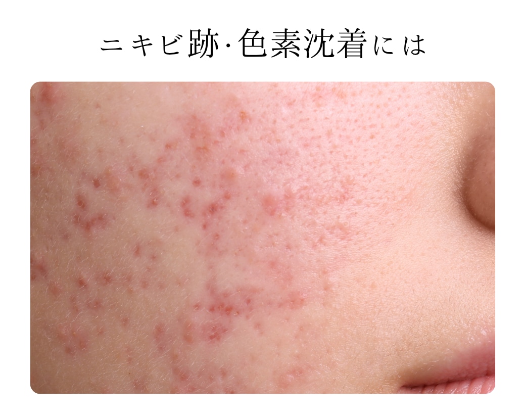 ニキビ跡・色素沈着にお悩みの方へ
