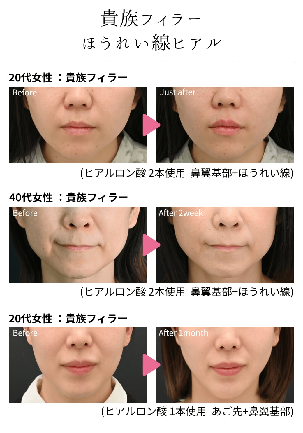 貴族フィラー症例一覧