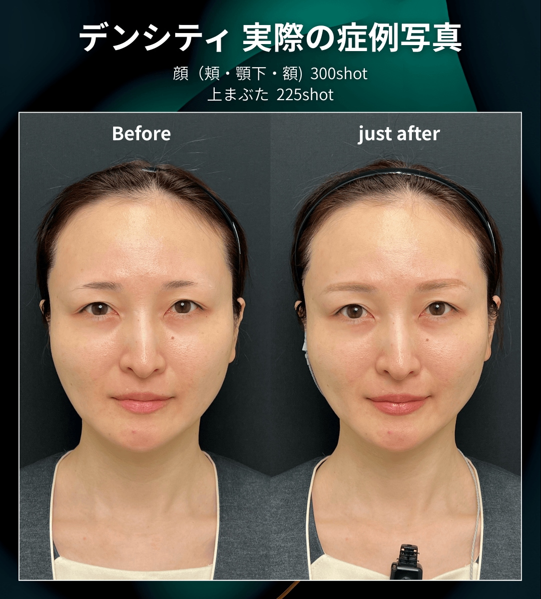 術直後からリフトアップ＆引き締めを実感