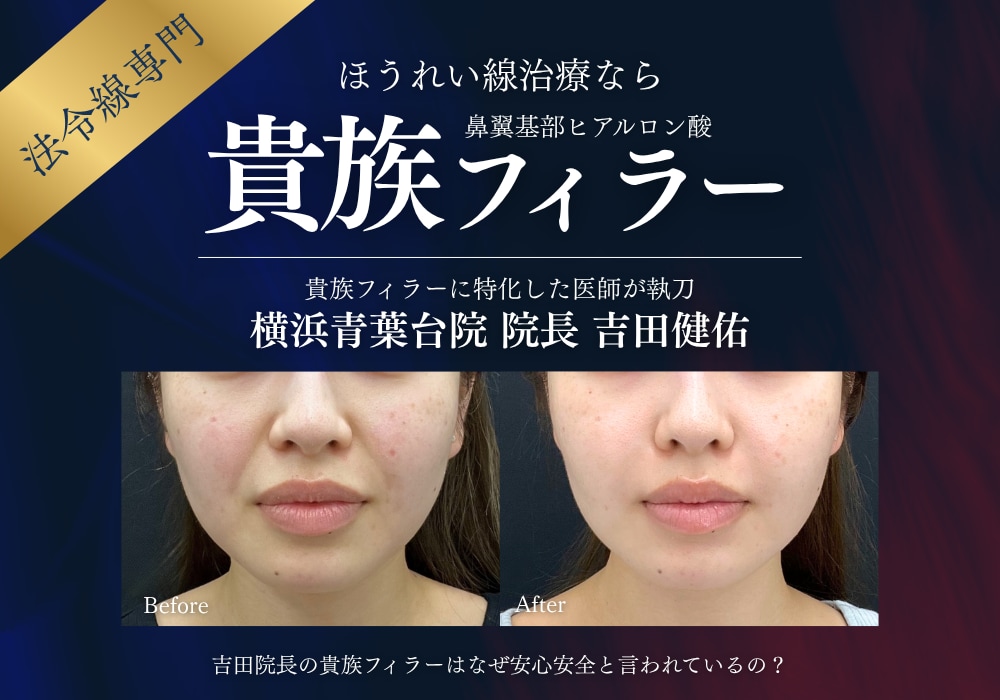 【ほうれい線治療】話題の貴族フィラー・貴族ヒアルで自然に若返り|湘南美容クリニック横浜青葉台院