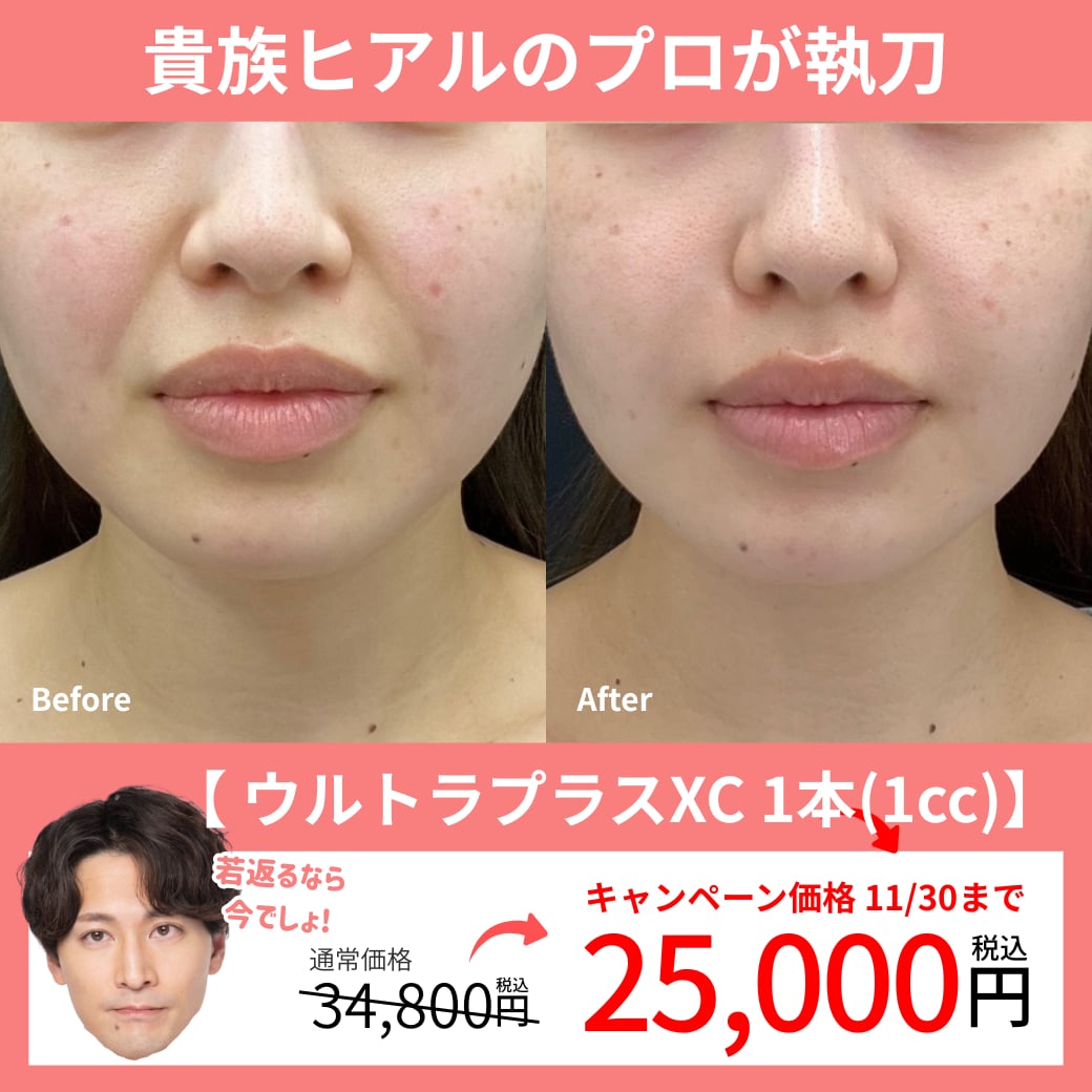 ほうれい線ヒアルがお得に