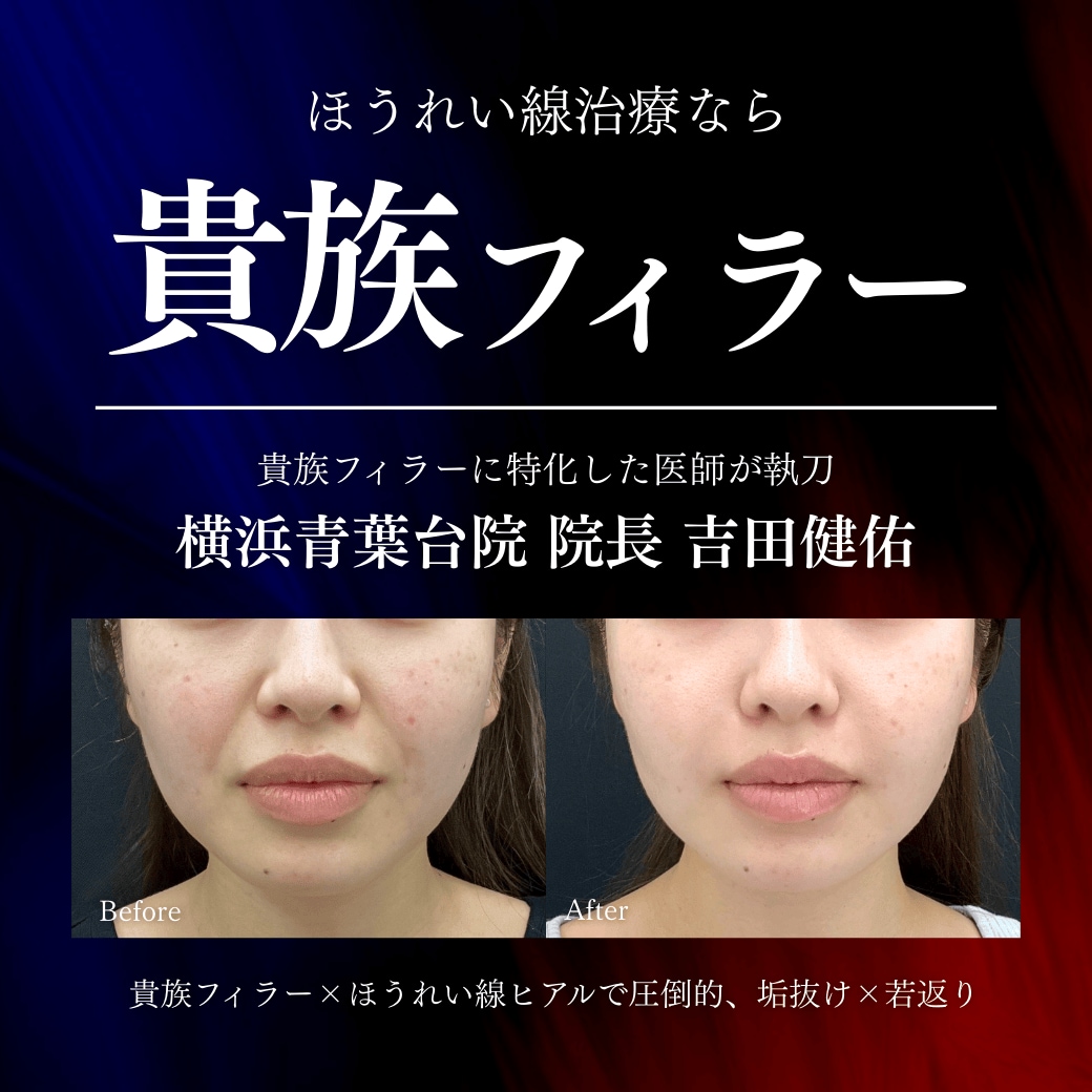【ほうれい線治療】ほうれい線に効く“貴族フィラー”で即効＆自然に若返る！横浜青葉台院Dr.吉田