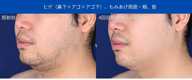 <b>1位:ヒゲ脱毛(髭3点:もみあげ+ほほ)</b>