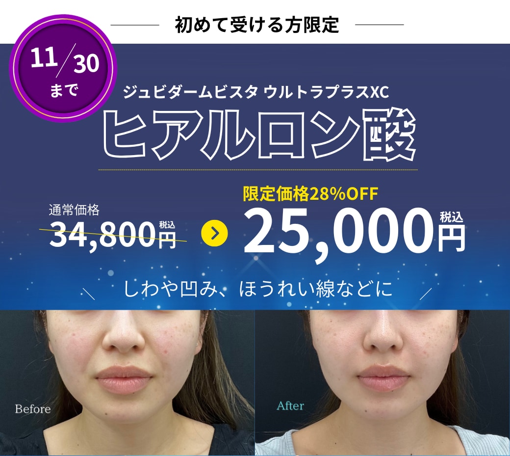 ウルトラプラスXCが28％OFF🔥