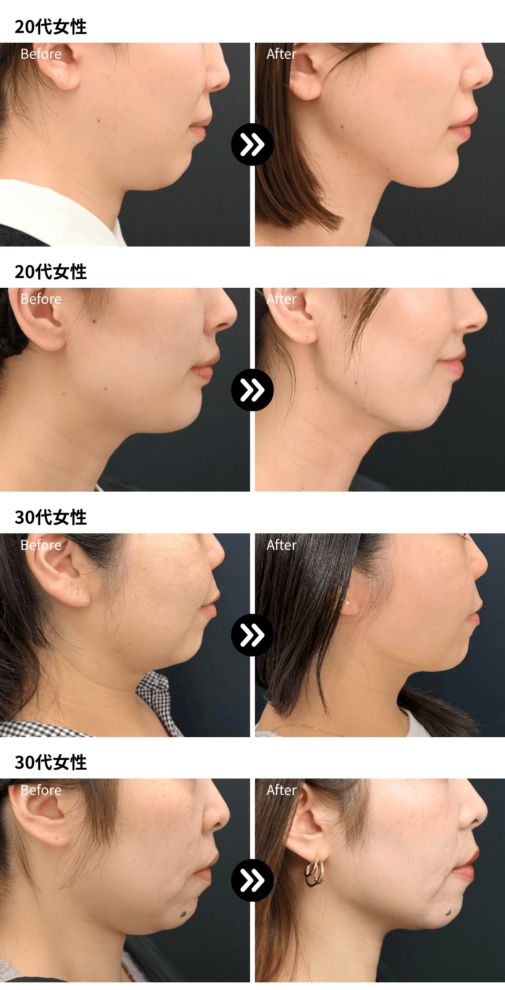 輪郭形成で横顔を整える