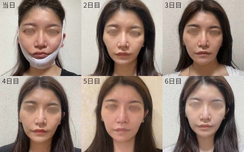 脂肪吸引注射｜ダウンタイム最小限
