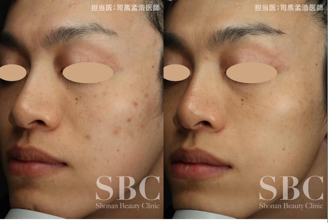 【毛穴・ニキビ跡】内側から凹凸を押し上げる集中治療