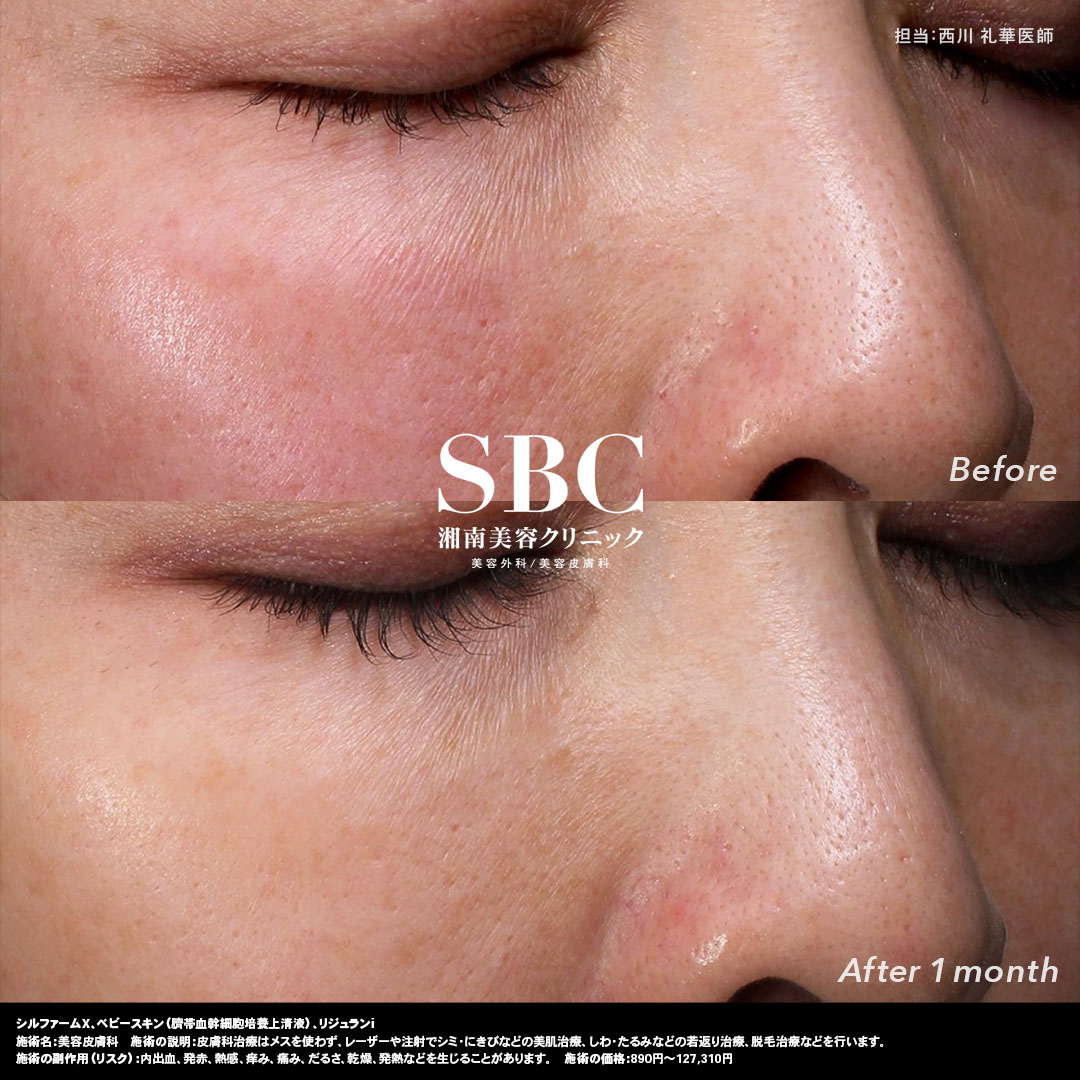 【小じわ・ハリ・肌質改善】全体的なエイジングケア