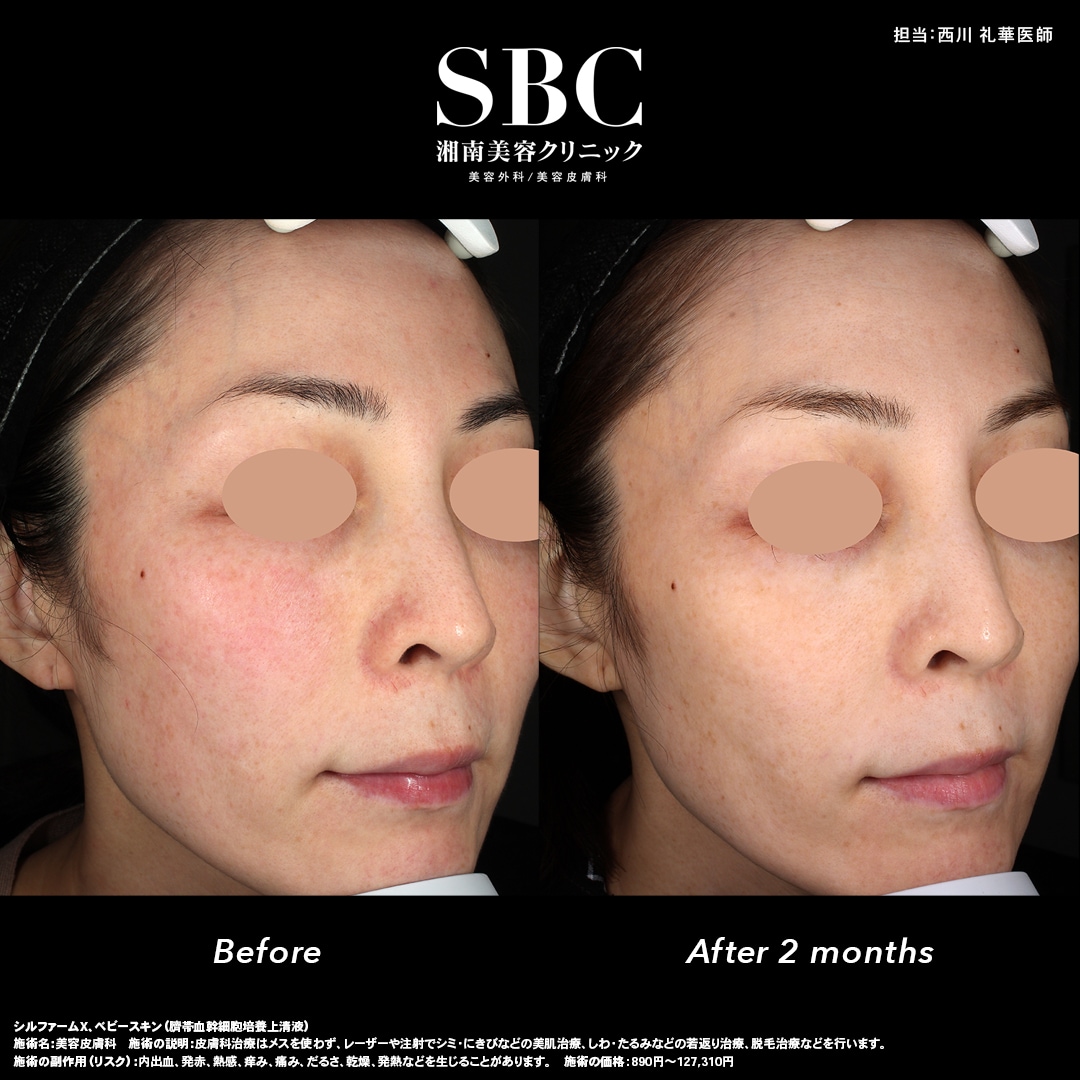 【肝斑・赤ら顔】従来の治療で難しかった悩みに終止符を