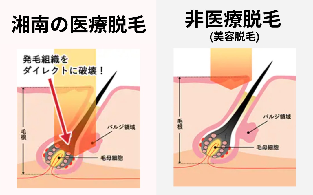 あなたに合うのはどっち？