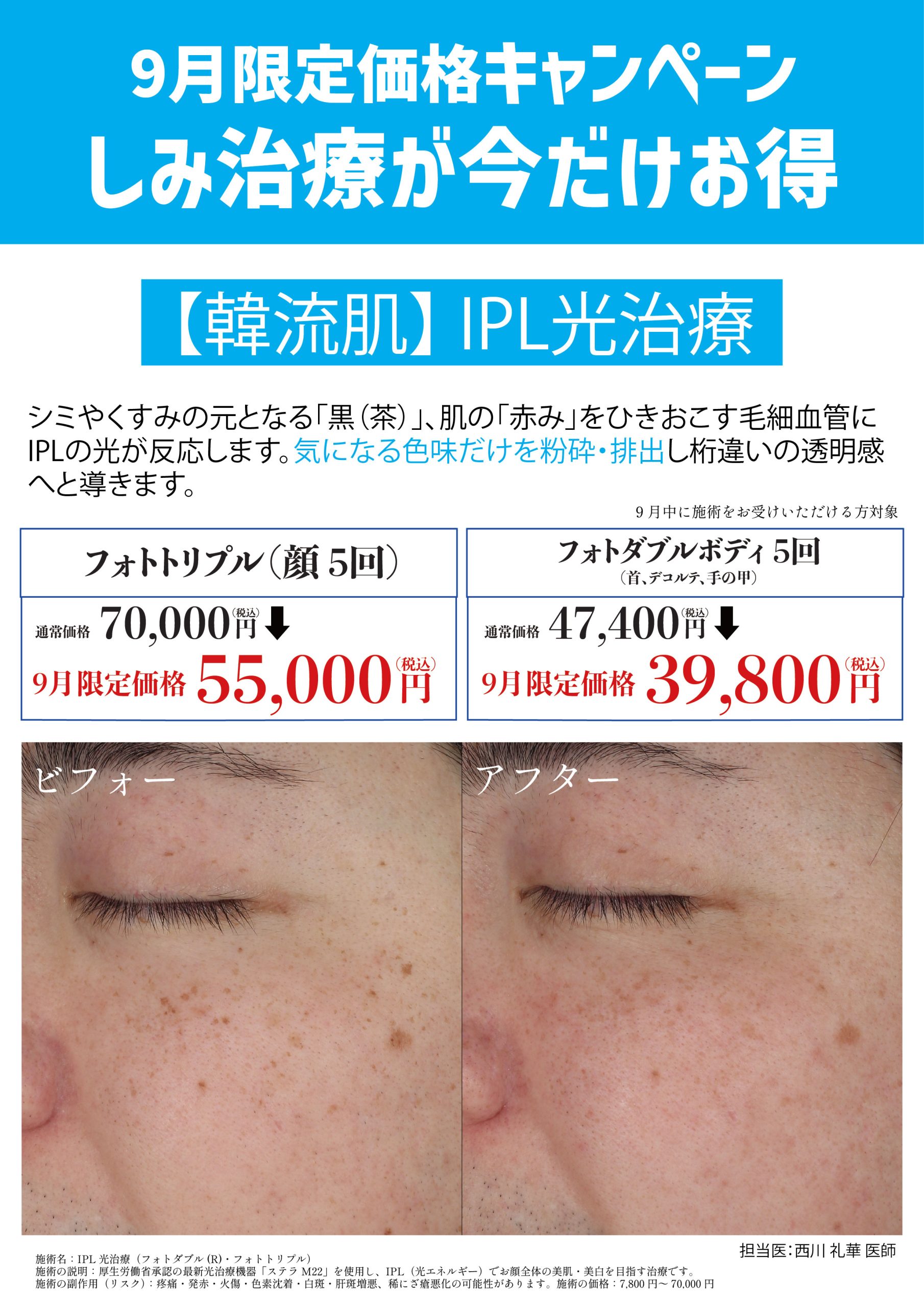 IPL光治療 （ステラM22）