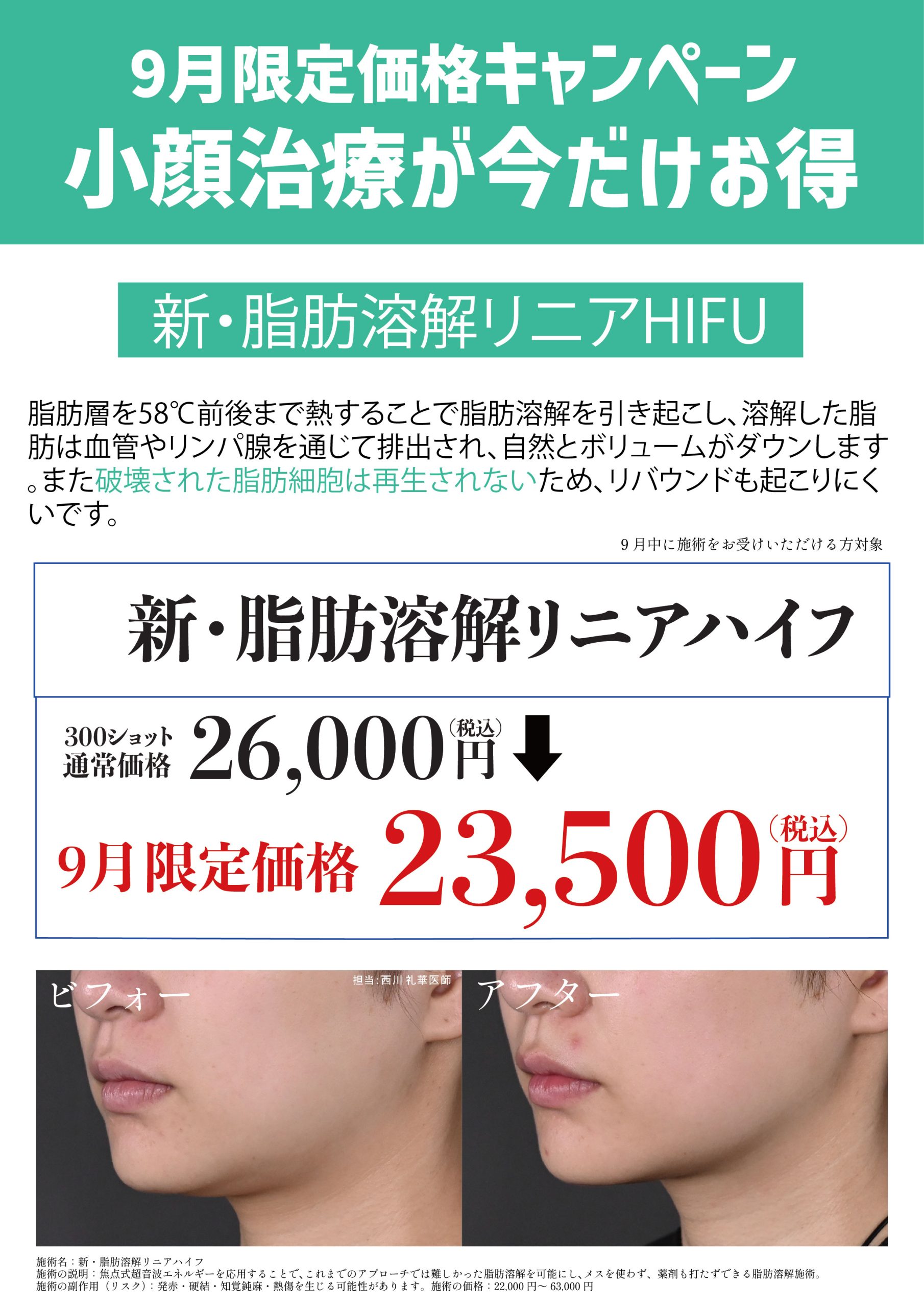 脂肪溶解リニアハイフ
