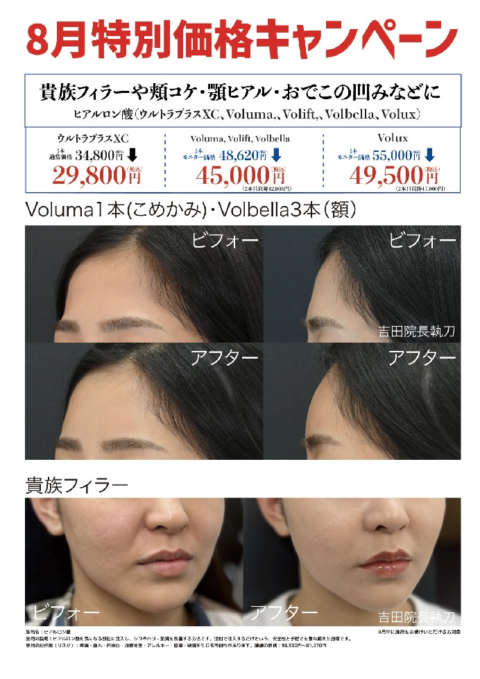 ヒアルロン酸