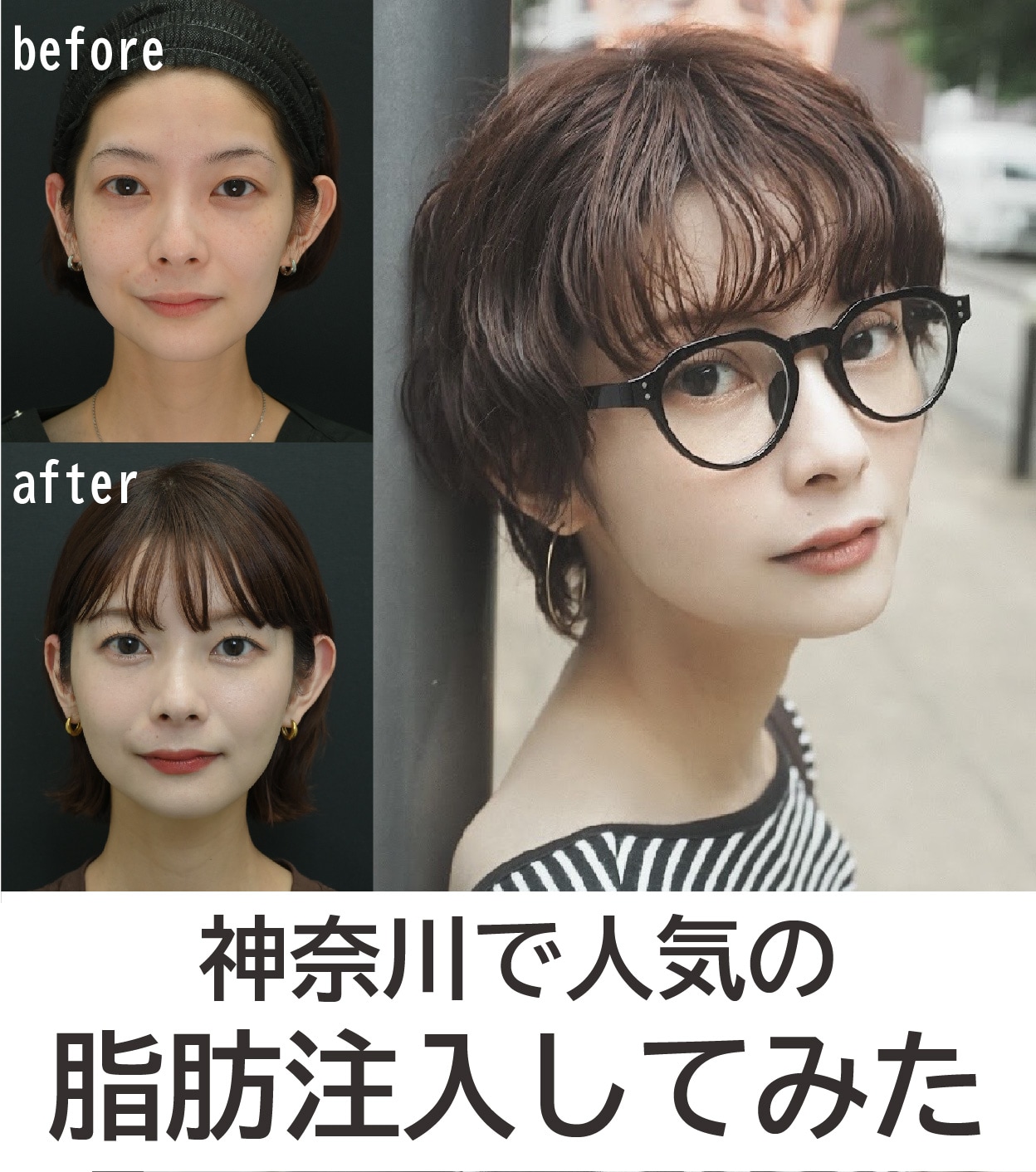 【2026年最新】神奈川で顔の脂肪注入の若返り!【湘南美容クリニック横浜青葉台院】