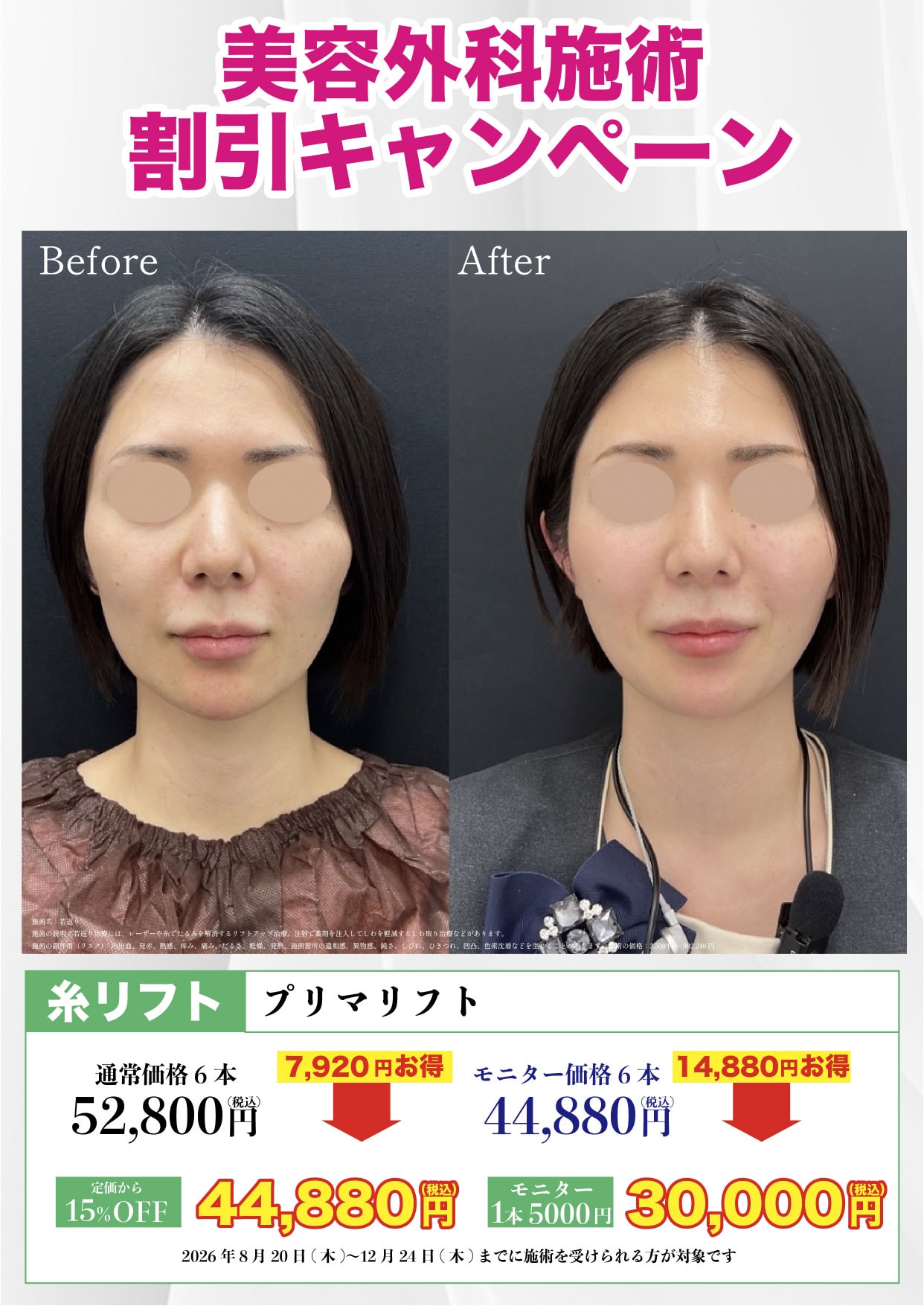 糸リフト（スレッドリフト）
