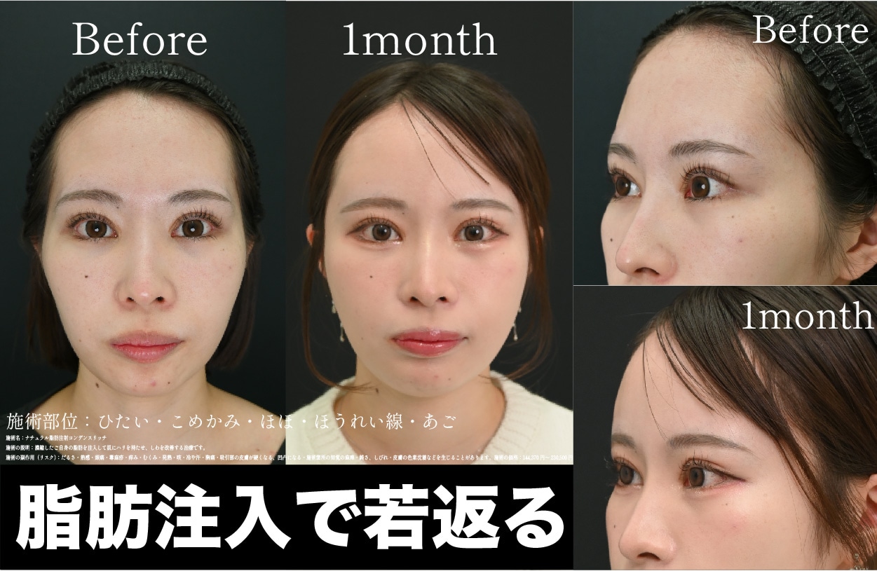 【2026年最新】町田・横浜で受ける顔の脂肪注入でまん丸おでこに!【湘南美容クリニック横浜青葉台院】
