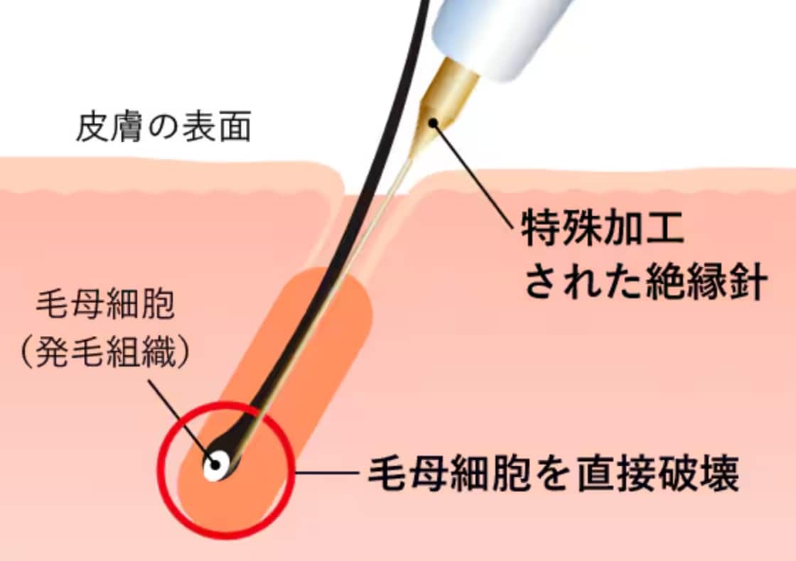 ニードル脱毛の仕組みを解説