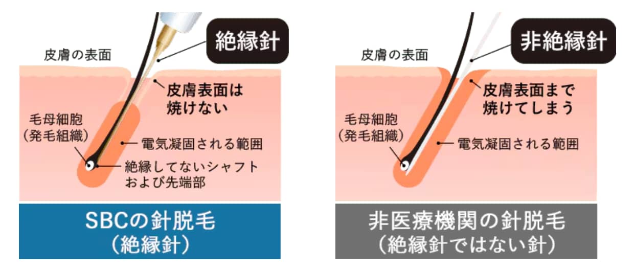 絶縁針とは？