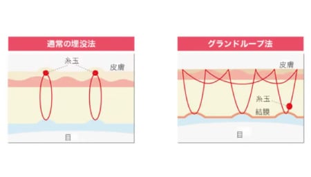 湘南美容クリニックの中でも2名の医師のみが執刀可能な二重術