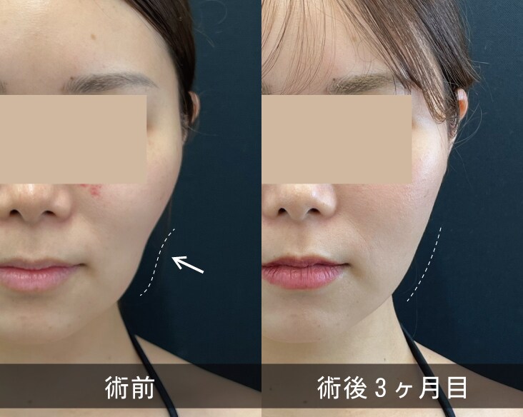頬のコケが気になる方
