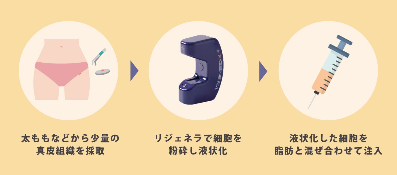 リジェネラとは?