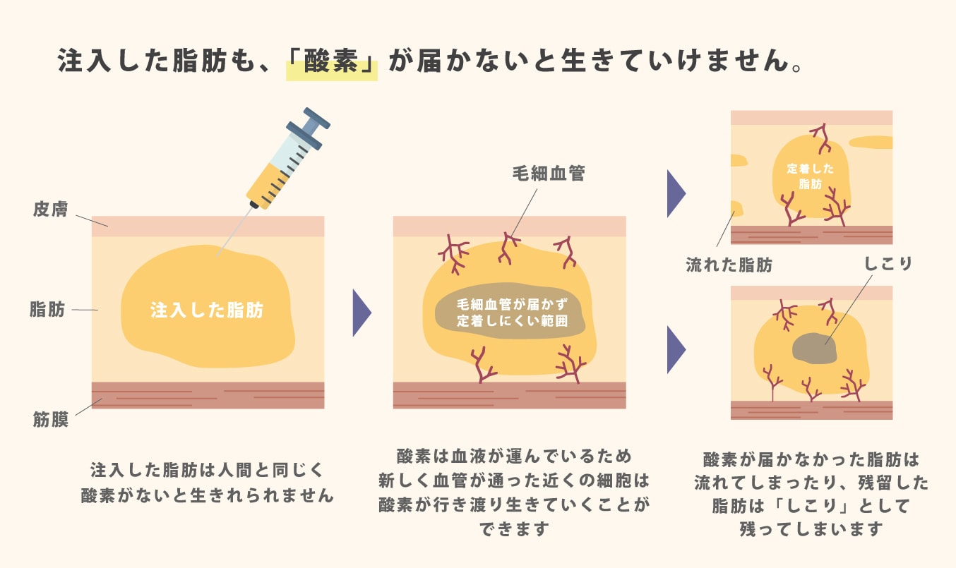 どうして定着しない脂肪があるの?