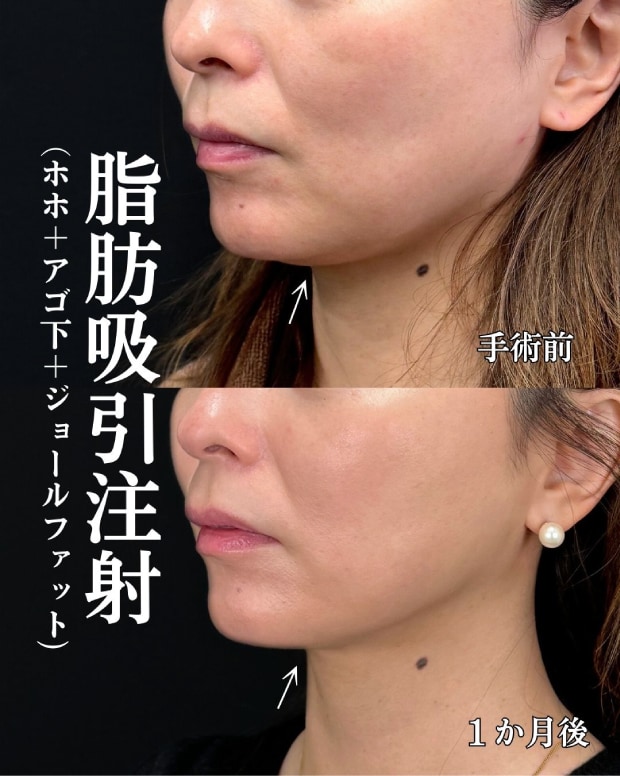 脂肪吸引注射とは？