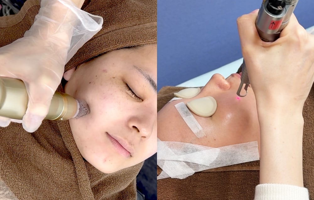 ピーリング後の「＋α」で理想の肌へ