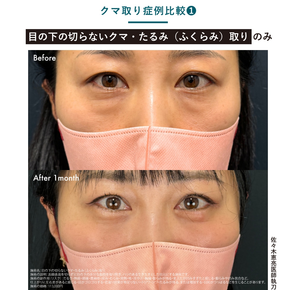 目の下の切らないクマ取り・たるみ（ふくらみ）取り（脱脂術）のみ