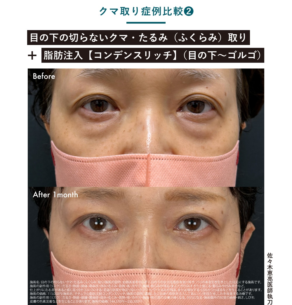 目の下の切らないクマ取り・たるみ（ふくらみ）取り（脱脂術）＋脂肪注入