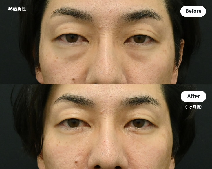 坂西医師による裏ハムラ法