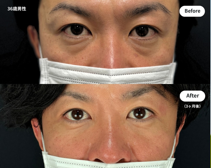 佐々木医師による目の下の切らないクマ取り